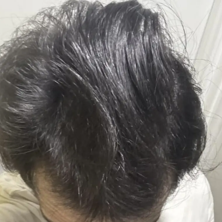 Alopécie diffuse — femme — après